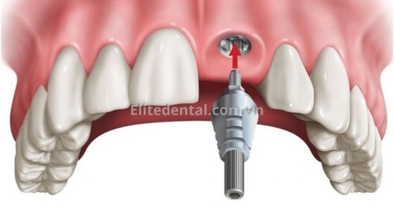 Tại sao trồng implant răng cửa phức tạp hơn răng hàm