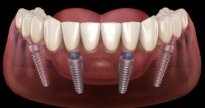Trồng răng implant all on 4 giá bao nhiêu
