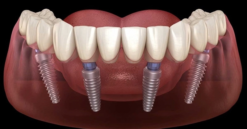 Trồng răng implant all on 4 giá bao nhiêu