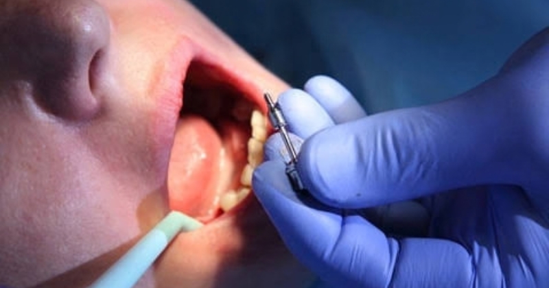 Trồng răng implant có đau không