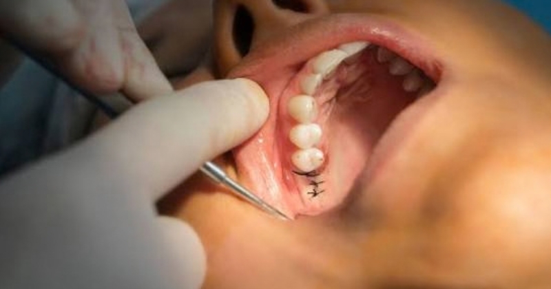 Trồng răng implant có nguy hiểm không