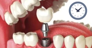 Trồng răng implant mất bao lâu thì hoàn thành