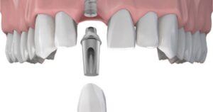 Trồng răng implant răng cửa