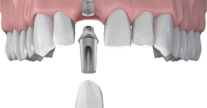 Trồng răng implant răng cửa