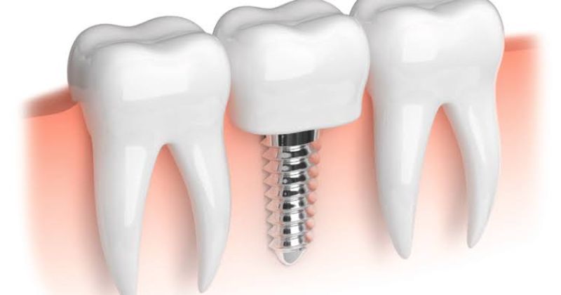 Trường hợp nào nên chọn trồng răng Implant Neodent