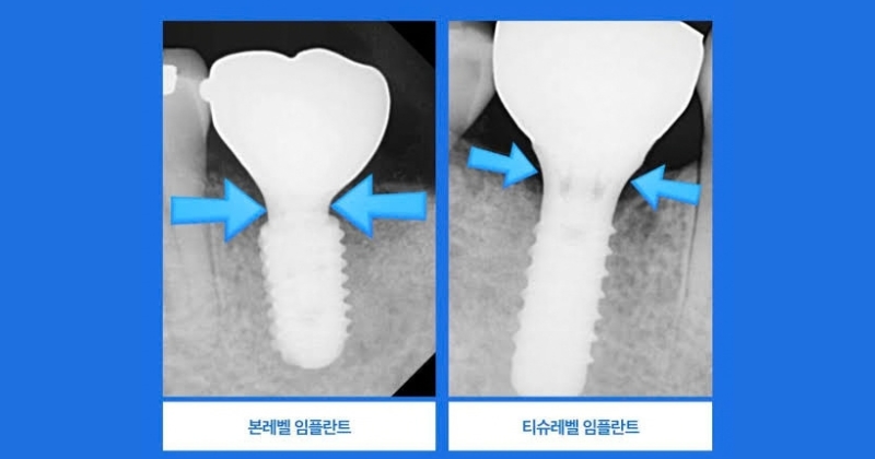 Trường hợp nào nên lựa chọn trụ Implant Osstem