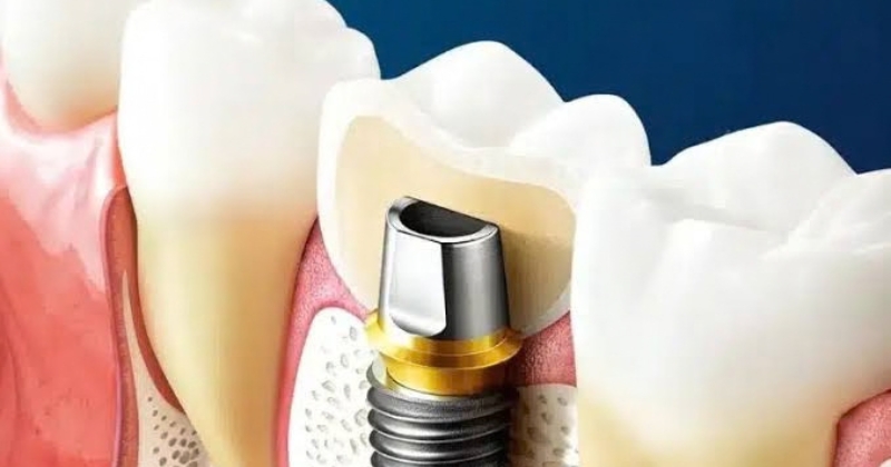 Ưu nhược điểm của trụ răng Implant Osstem