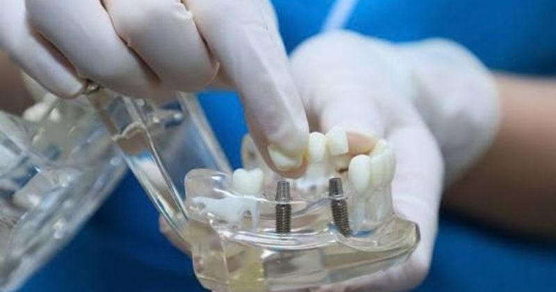 Vai trò cốt lõi của khớp nối abutment implant