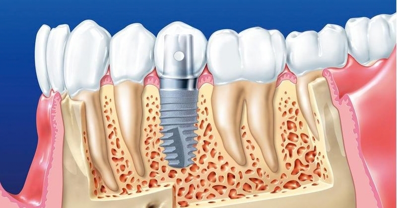 Vì sao nên chọn cấy ghép răng implant thay vì phương pháp cũ