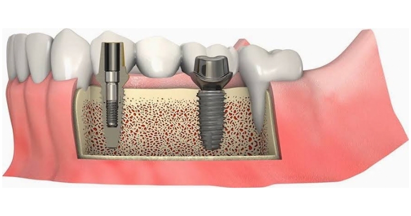 chi phí phát sinh trước khi cắm Implant