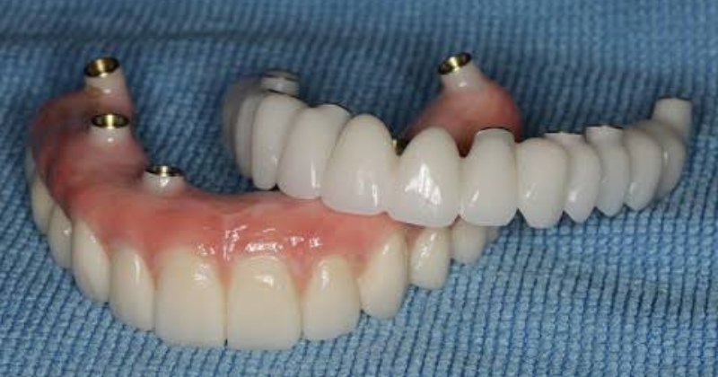 nguy cơ từ dịch vụ cắm Implant giá rẻ