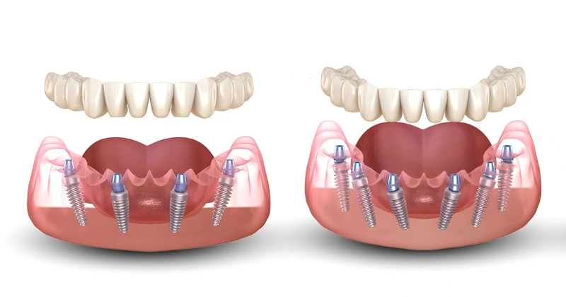 phương pháp implant all on 4 và implant all on 6