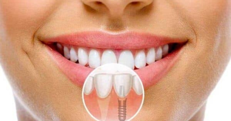 yếu tố quyết định làm răng Implant
